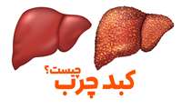 فوق تخصص گوارش و کبد : بسیاری از مردم کبد چرب دارند اما چون علامتی نداشته  از آن مطلع نیستند