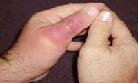 سم مار ها  و اثر آن بر بدن متفاوت است/در صورت گزش مار  فورا به مرکز درمانی مراجعه شود 